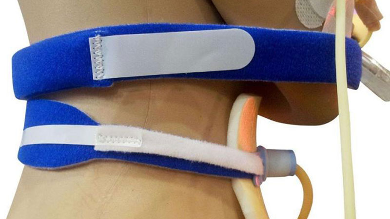 Supports de stabilisation pour tube de trachéotomie